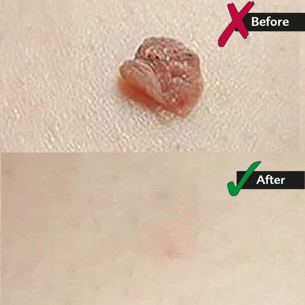 Skin Tag Removal Kit | Made In United Kingdom طقم إزالة الزوائد الجلدية صنع في المملكة المتحدة