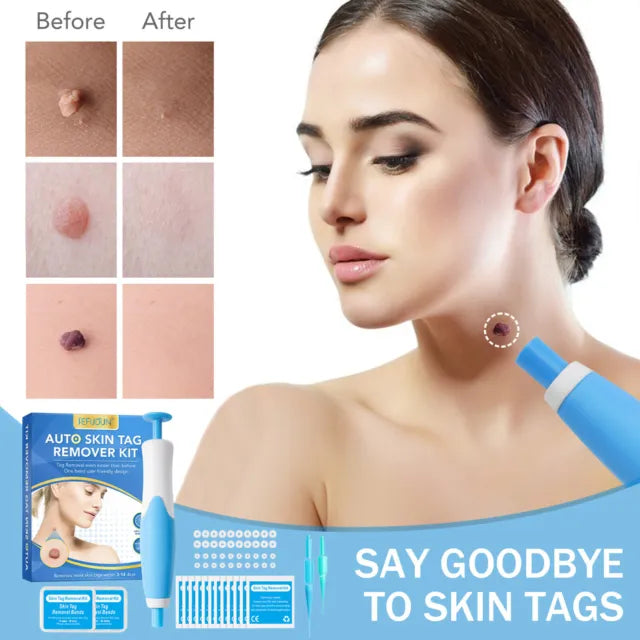 Skin Tag Removal Kit | Made In United Kingdom طقم إزالة الزوائد الجلدية صنع في المملكة المتحدة