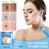 Skin Tag Removal Kit | Made In United Kingdom