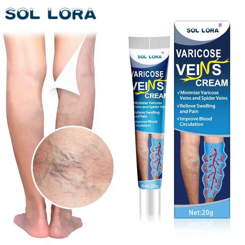 Varicose veins