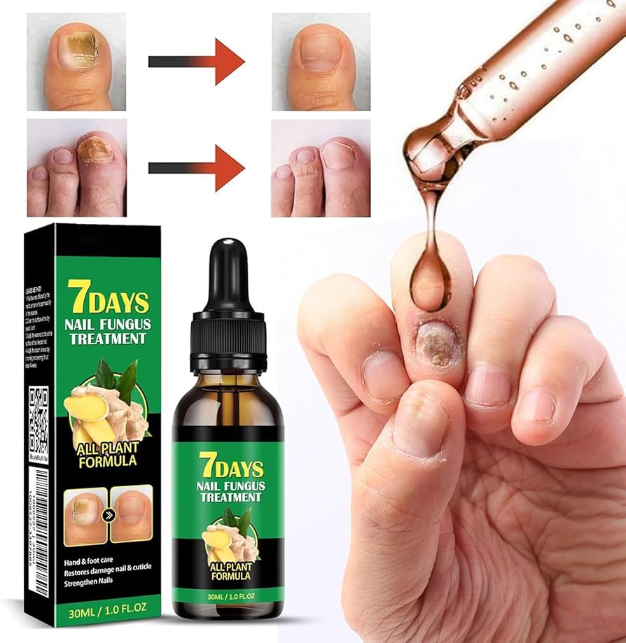 Ginger Nail Fungus Treatment Oil زيت علاج فطريات الأظافر بالزنجبيل