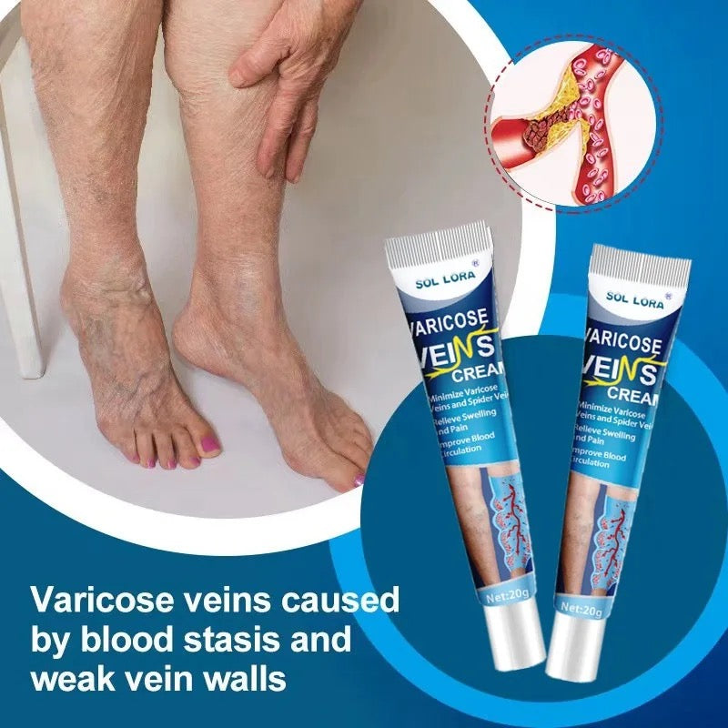 Varicose veins