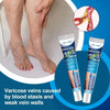 Varicose veins