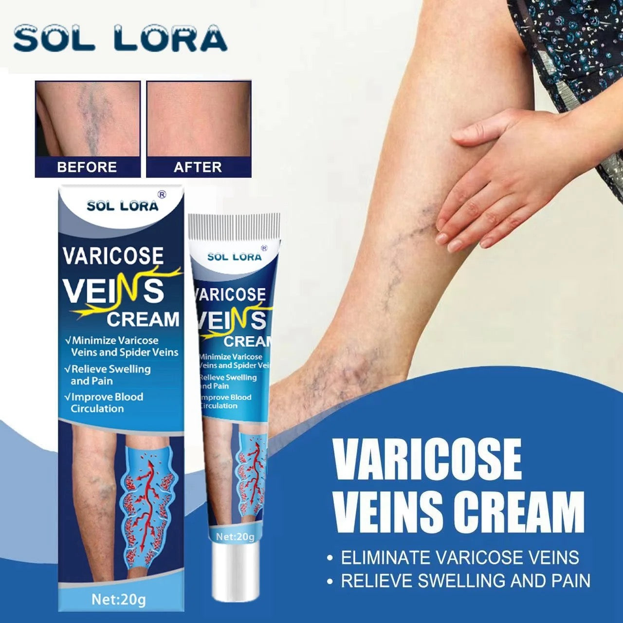 Varicose veins