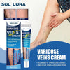 Varicose veins