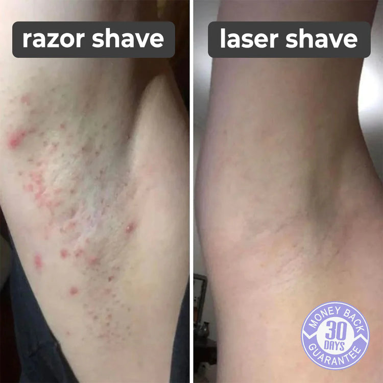SMARTEK® LASER SHAVER ماكينة حلاقة ليزر